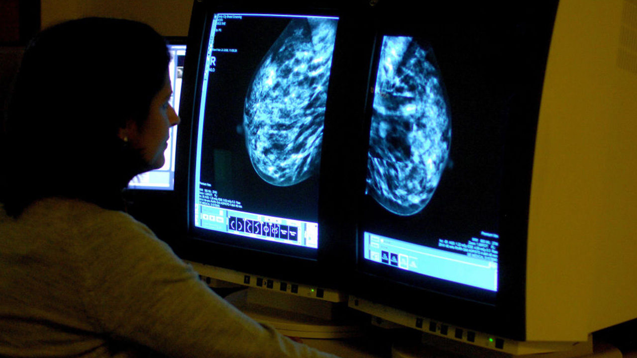 Targeted drug shrinks tumors in 3 out of 4 patients with advanced breast cancer — Palm Harbor Schools news